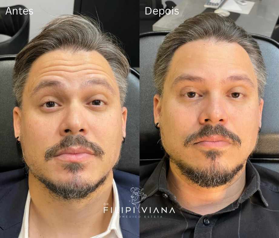 Antes e depois de toxina botulínica: linhas da testa suavizadas