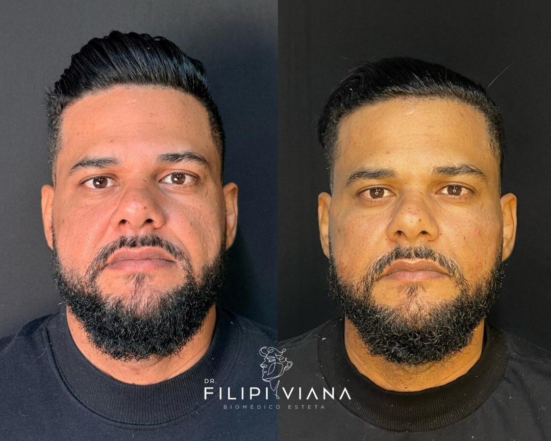 Antes e depois de harmonização masculina: rosto frontal de paciente com barba