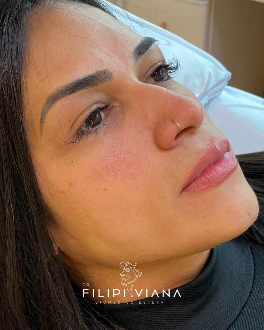 Lábios após preenchimento labial com contorno natural, vista de perfil