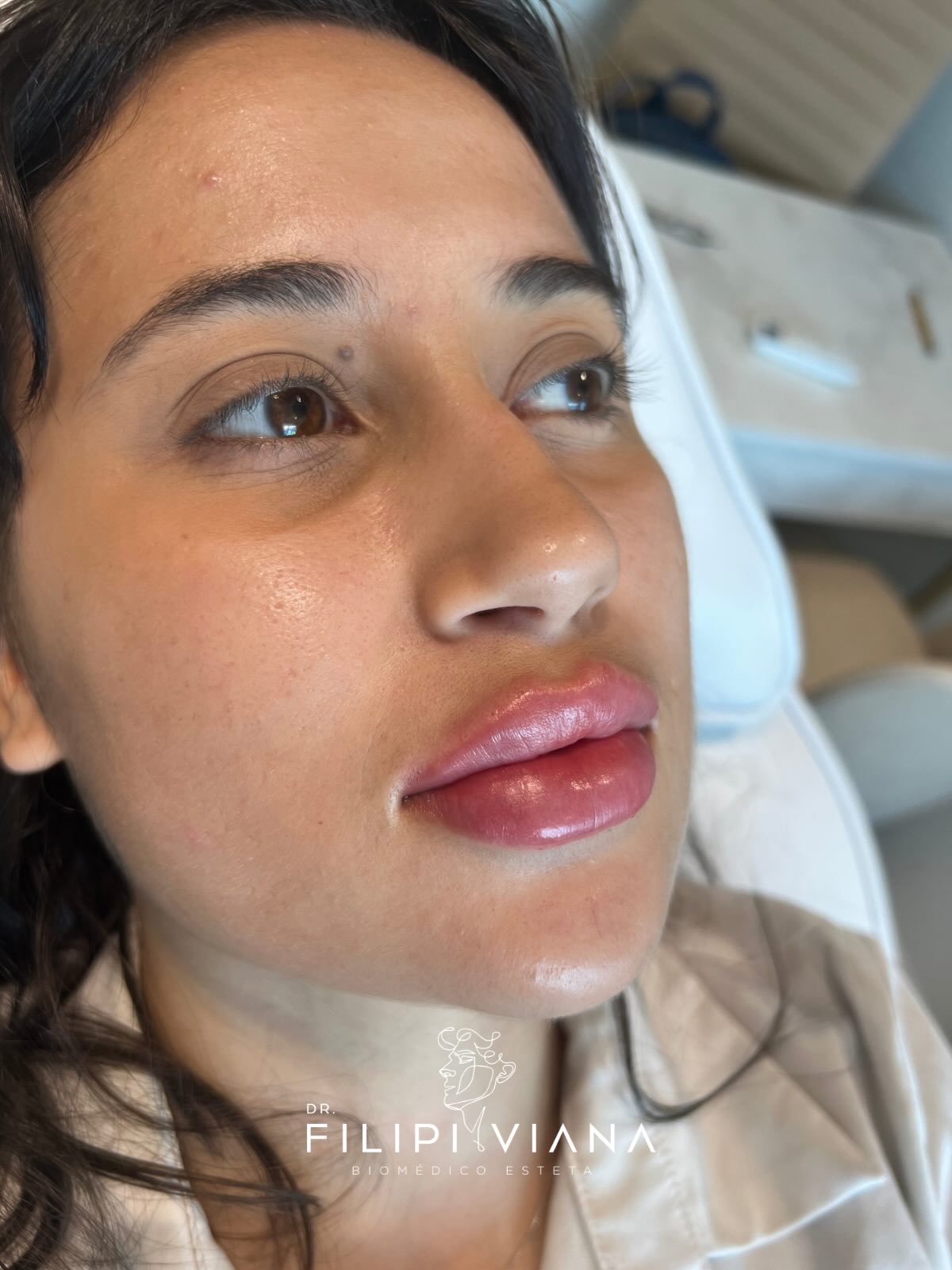 Lábios após preenchimento labial, vista em três quartos